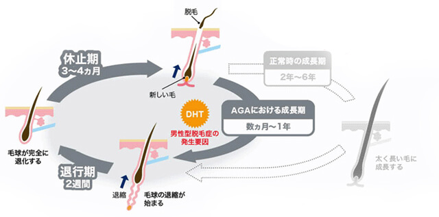 AGAのヘアサイクル